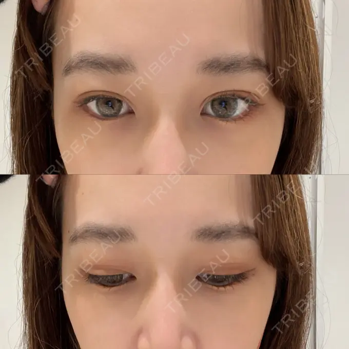 二重埋没 横浜TAクリニック DAY 9 メイン用