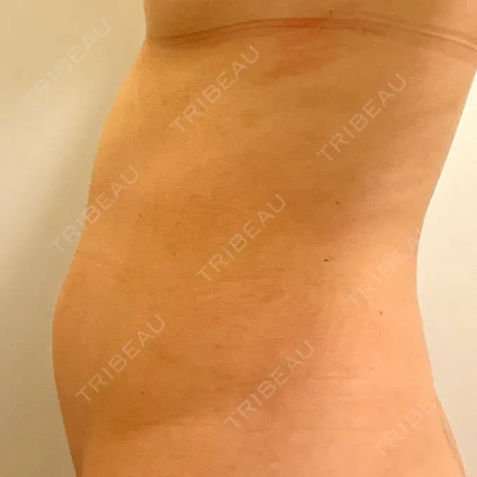 医療痩身（お腹） 吉井クリニック DAY 7 メイン用