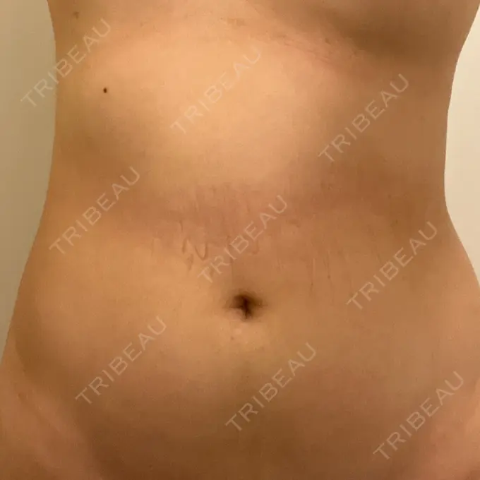 医療痩身（お腹） 吉井クリニック DAY 8 メイン用