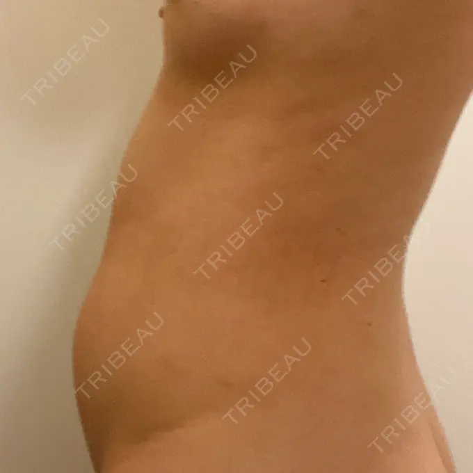 医療痩身（お腹） 吉井クリニック DAY 8 メイン用