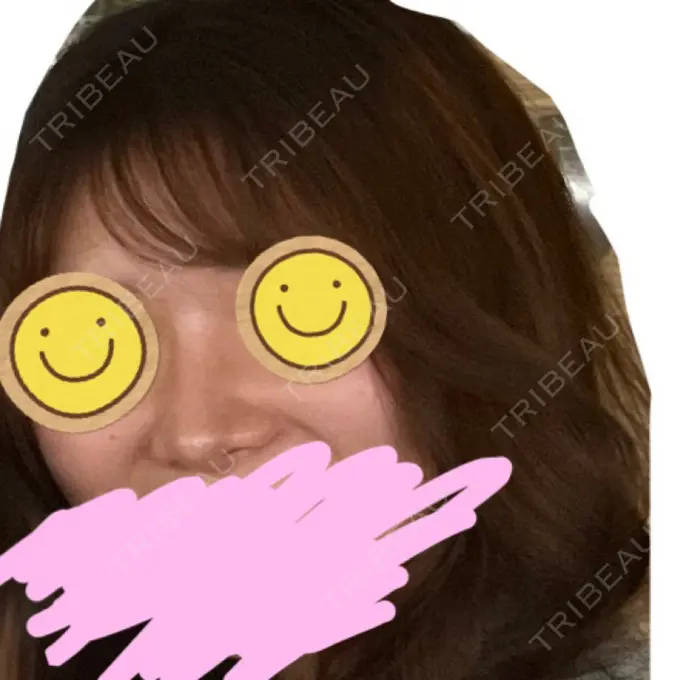 隆鼻術 / 鼻尖形成（切開） / 鼻中隔延長（切開） / 小鼻縮小（切開） / プロテーゼ除去 / 鼻尖縮小 FROM B整形外科 (旧バウム整形外科) DAY 1385 メイン用