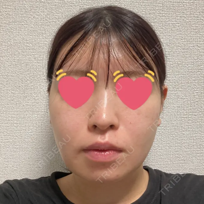 脂肪吸引（顔） / 脂肪冷却（輪郭） WOM CLINIC GINZA （ワム クリニック ギンザ） DAY 28 メイン用