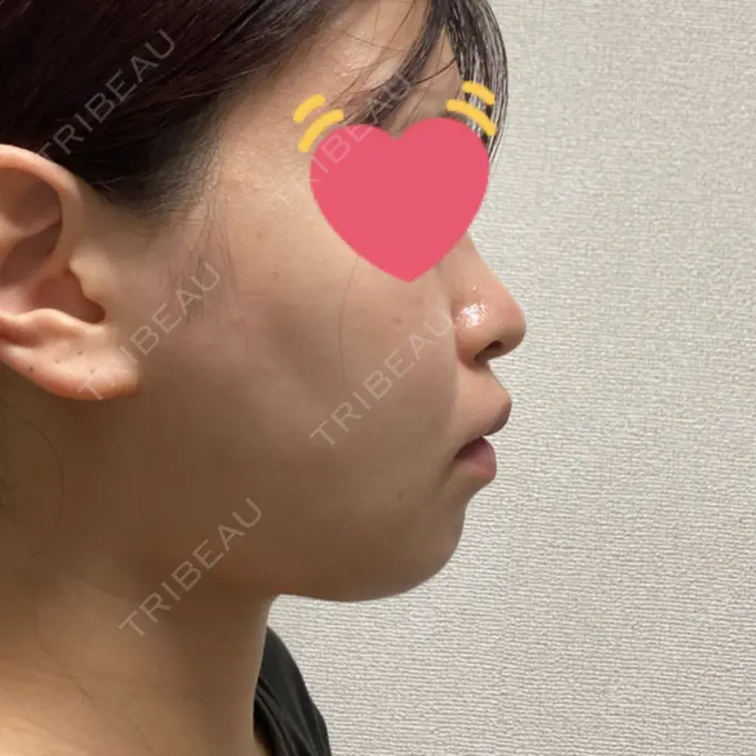 脂肪吸引（顔） / 脂肪冷却（輪郭） WOM CLINIC GINZA （ワム クリニック ギンザ） DAY 28 メイン用