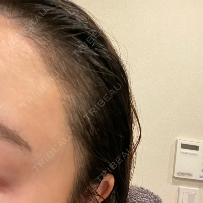 アートメイク（ヘアライン） トイトイトイクリニック 池袋院 DAY 7 メイン用