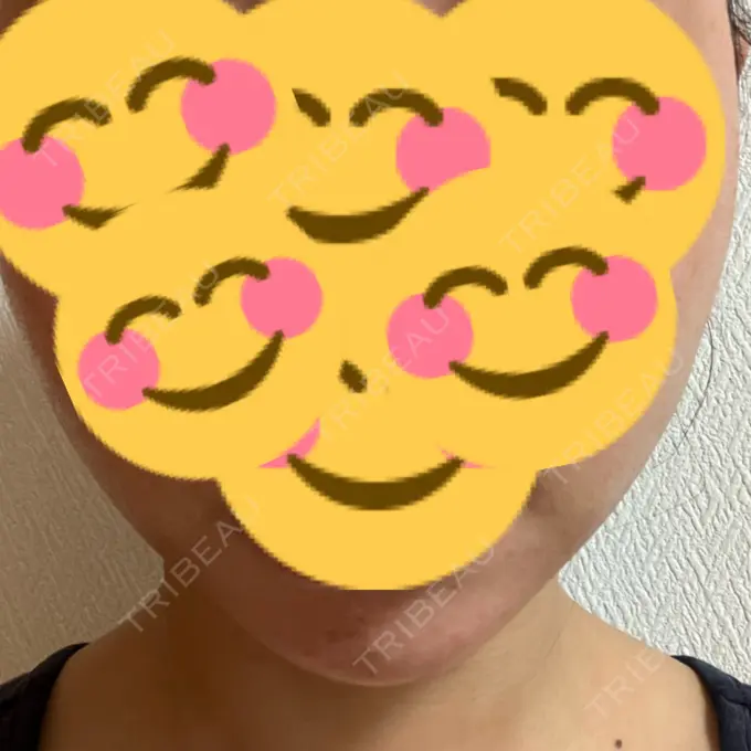 ボトックス（あご） / ヒアルロン酸注入（あご） TCB東京中央美容外科 八王子院 DAY 0 メイン用