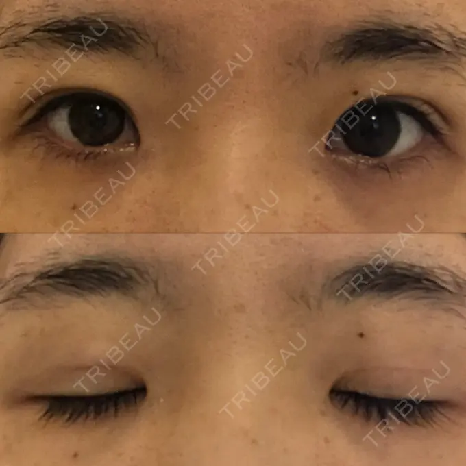 二重埋没 / 眼瞼下垂（非切開） WOM CLINIC GINZA （ワム クリニック ギンザ） DAY 15 メイン用