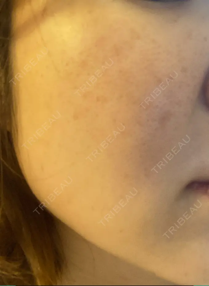 ピーリング（ニキビ・毛穴） / 光治療（フォトフェイシャルなど） アーククリニック AFTER メイン用