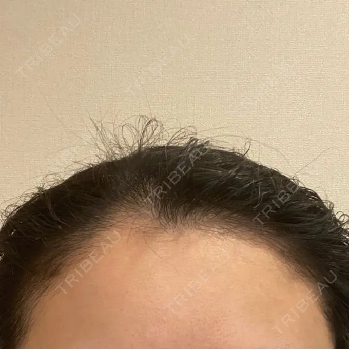 アートメイク（ヘアライン） トイトイトイクリニック 池袋院 DAY 8 メイン用