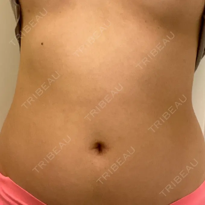 医療痩身（お腹） 吉井クリニック DAY 9 メイン用