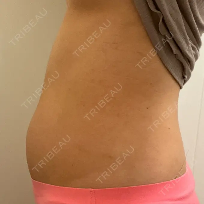 医療痩身（お腹） 吉井クリニック DAY 9 メイン用