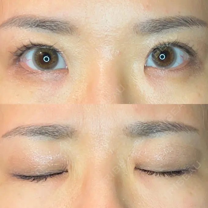 二重埋没 東京BELLEZZAクリニック AFTER メイン用