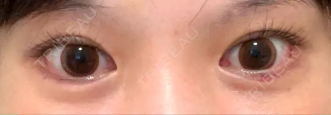 ヒアルロン酸注入（涙袋） 渋谷美容外科クリニック 渋谷院 DAY 2 メイン用