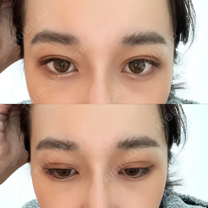 二重埋没 横浜TAクリニック DAY 12 メイン用