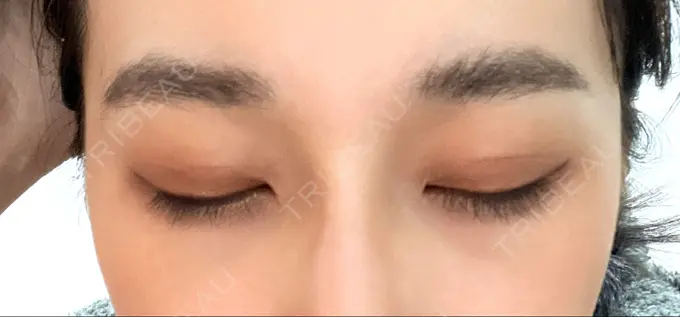 二重埋没 横浜TAクリニック DAY 12 メイン用