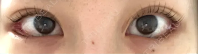 目尻切開 / タレ目形成・グラマラスライン（切開） / 目尻靭帯移動 BIOTOPE CLINIC 【ビオトープクリニック】 AFTER メイン用