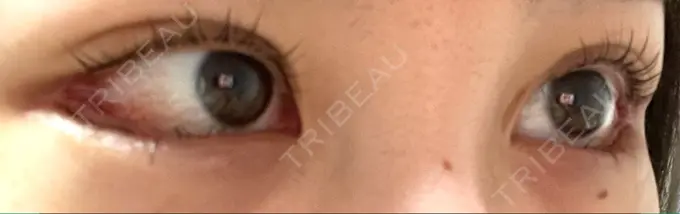 目尻切開 / タレ目形成・グラマラスライン（切開） / 目尻靭帯移動 BIOTOPE CLINIC 【ビオトープクリニック】 DAY 20 メイン用