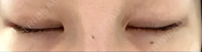 目尻切開 / タレ目形成・グラマラスライン（切開） / 目尻靭帯移動 BIOTOPE CLINIC 【ビオトープクリニック】 DAY 20 メイン用