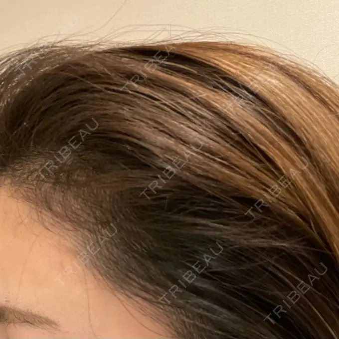 アートメイク（ヘアライン） トイトイトイクリニック 池袋院 DAY 9 メイン用