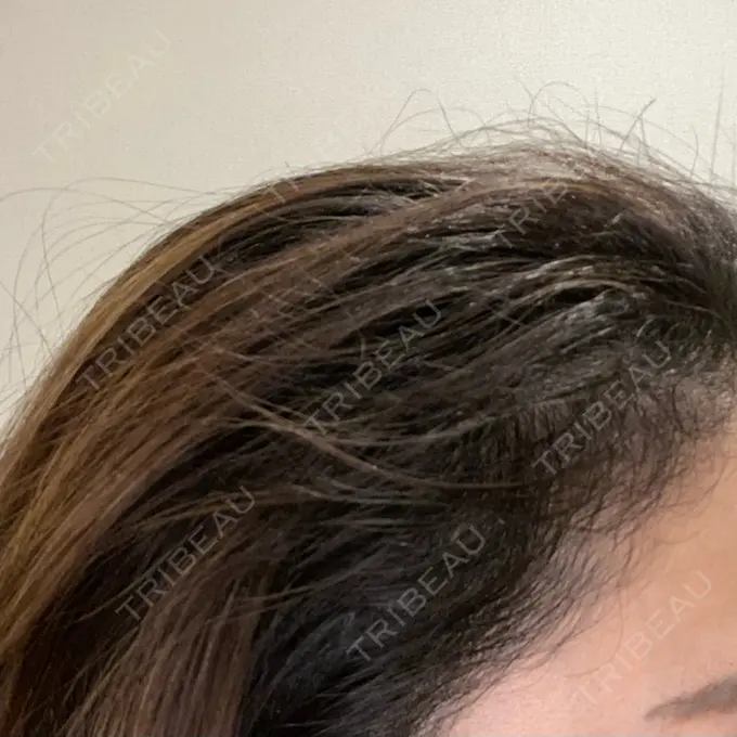 アートメイク（ヘアライン） トイトイトイクリニック 池袋院 DAY 9 メイン用