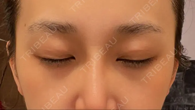 二重埋没 横浜TAクリニック DAY 13 メイン用