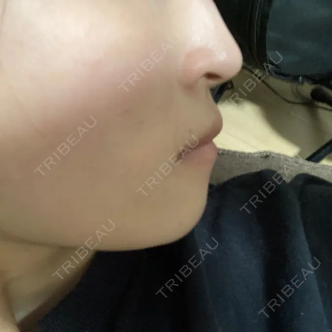 ボトックス（人中） Rosa Beauty Clinic AFTER メイン用