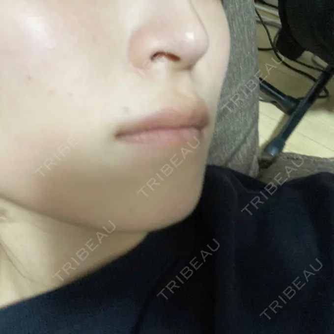 ボトックス（人中） Rosa Beauty Clinic DAY 9 メイン用