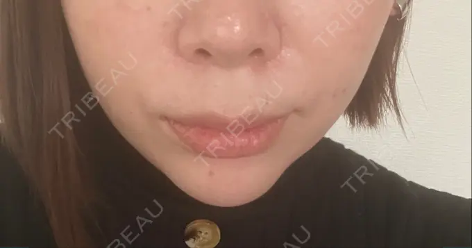 ボトックス（あご） / ヒアルロン酸注入（あご） veary clinic DAY 8 メイン用