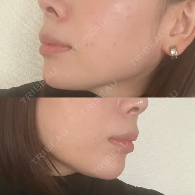 ボトックス（あご） / ヒアルロン酸注入（あご） veary clinic DAY 8 メイン用