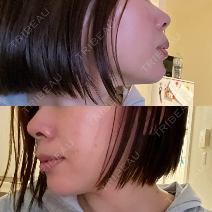 ボトックス（あご） / ヒアルロン酸注入（あご） veary clinic DAY 0 メイン用