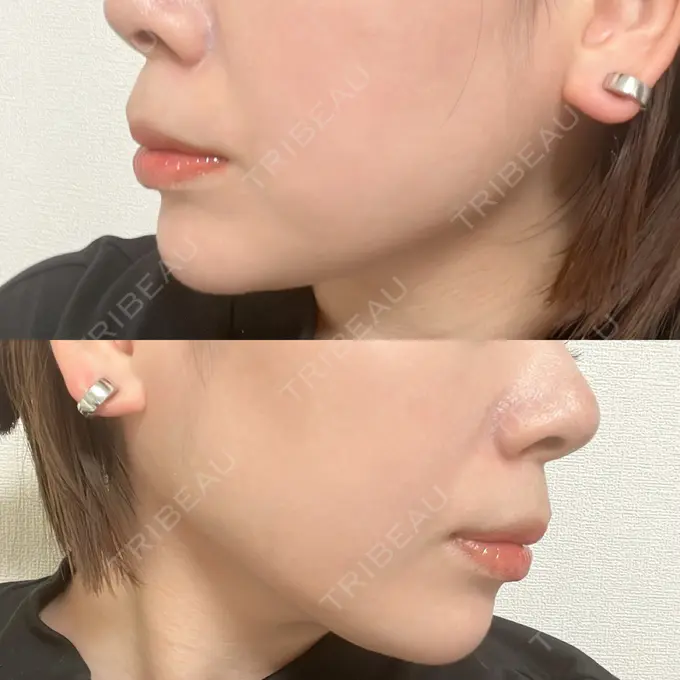 ボトックス（あご） / ヒアルロン酸注入（あご） veary clinic AFTER メイン用