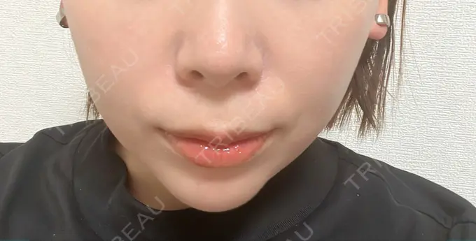 ボトックス（あご） / ヒアルロン酸注入（あご） veary clinic DAY 10 メイン用