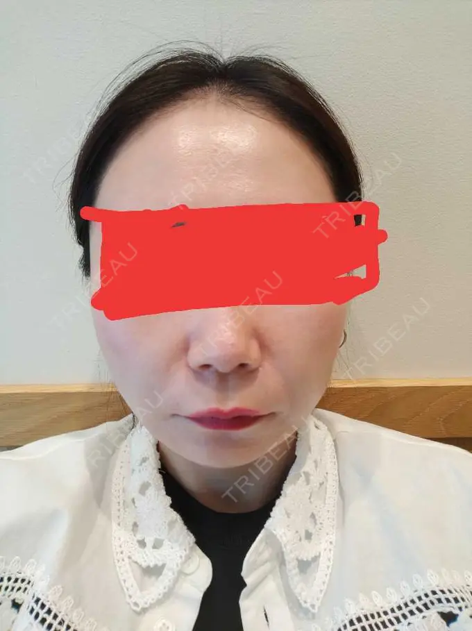 糸リフト / 脂肪吸引（顔） / メーラーファット除去 湘南美容クリニック 秋葉原院 DAY 46 メイン用