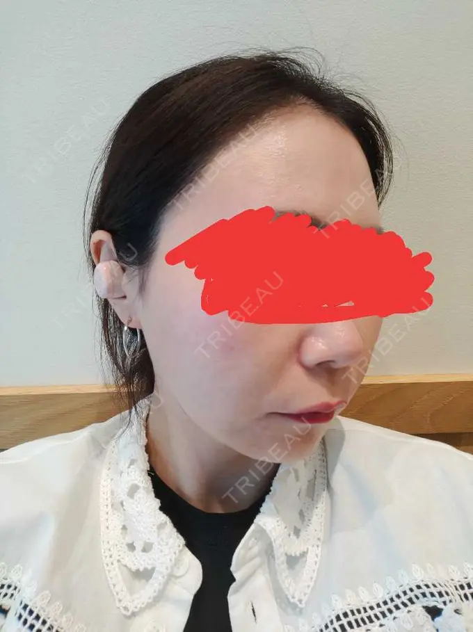 糸リフト / 脂肪吸引（顔） / メーラーファット除去 湘南美容クリニック 秋葉原院 DAY 46 メイン用