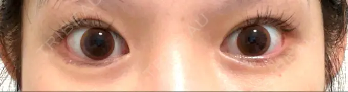 ヒアルロン酸注入（涙袋） 渋谷美容外科クリニック 渋谷院 DAY 5 メイン用