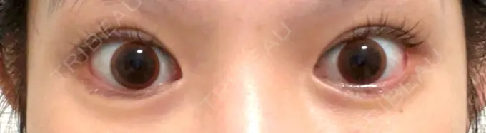 ヒアルロン酸注入（涙袋） 渋谷美容外科クリニック 渋谷院 DAY 6 メイン用