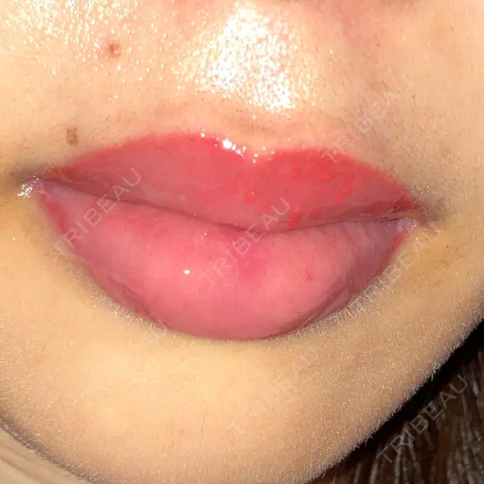 アートメイク（唇） X CLINIC 大阪院 DAY 117 メイン用