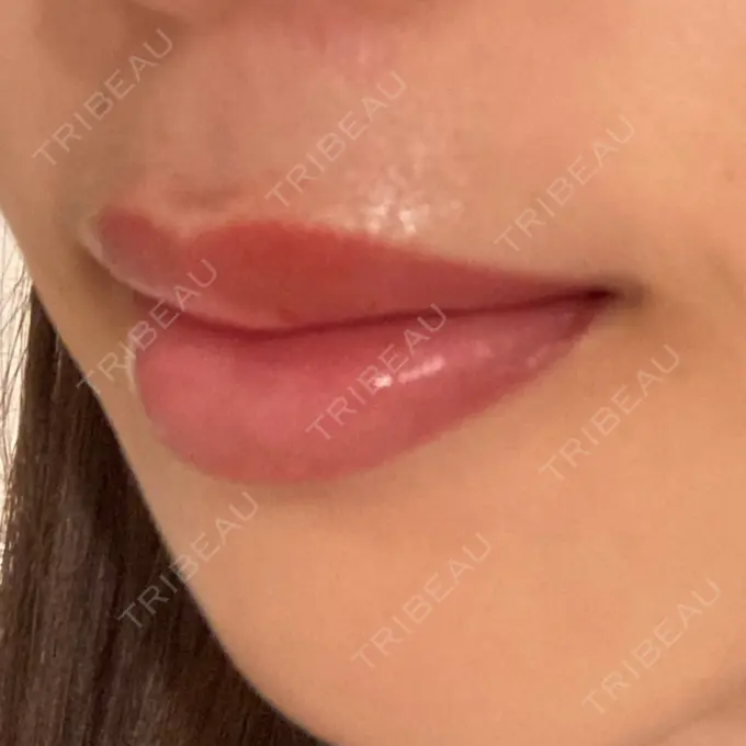 アートメイク（唇） X CLINIC 大阪院 DAY 118 メイン用