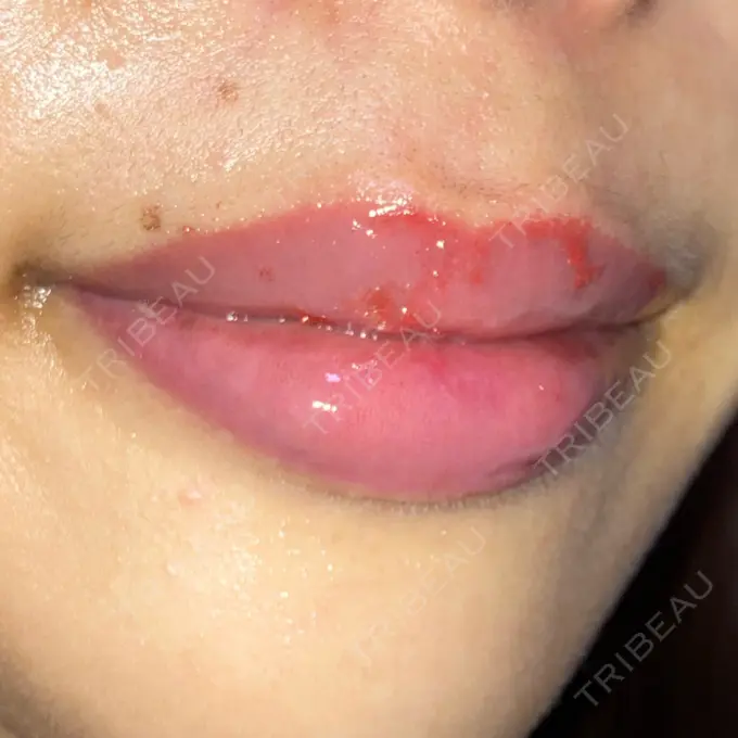 アートメイク（唇） X CLINIC 大阪院 DAY 118 メイン用