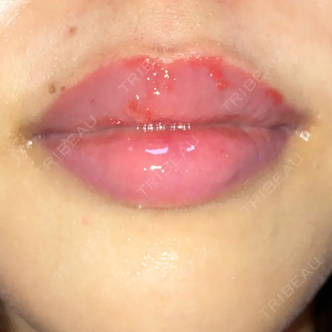 アートメイク（唇） X CLINIC 大阪院 DAY 118 メイン用