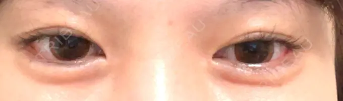 ヒアルロン酸注入（涙袋） 渋谷美容外科クリニック 渋谷院 DAY 8 メイン用