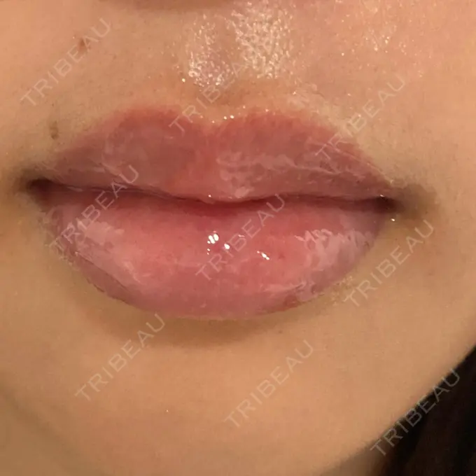 アートメイク（唇） X CLINIC 大阪院 AFTER メイン用
