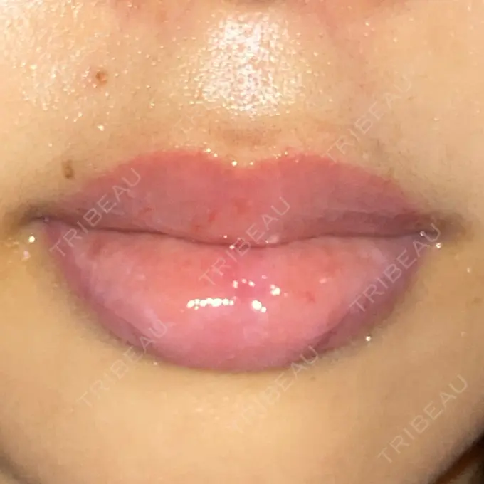 アートメイク（唇） X CLINIC 大阪院 DAY 119 メイン用