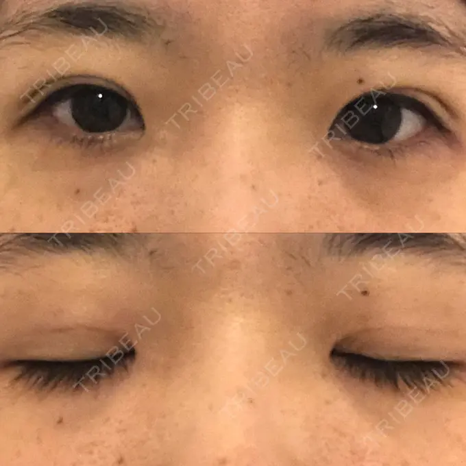 二重埋没 / 眼瞼下垂（非切開） WOM CLINIC GINZA （ワム クリニック ギンザ） DAY 22 メイン用