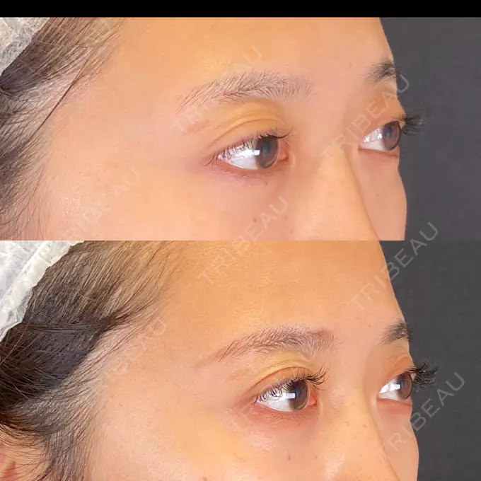 眼瞼下垂（非切開） SOL CLINIC DAY 32 メイン用