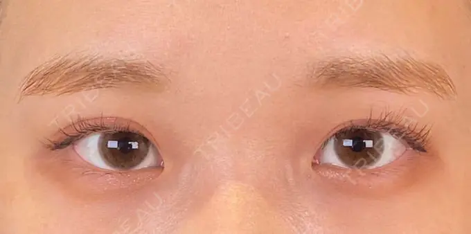 二重埋没 SOL CLINIC AFTER メイン用