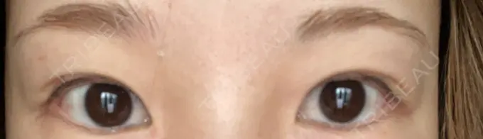 目尻切開 TCB東京中央美容外科 金沢院 AFTER メイン用