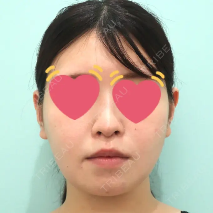 脂肪吸引（顔） / 脂肪冷却（輪郭） WOM CLINIC GINZA （ワム クリニック ギンザ） DAY 31 メイン用