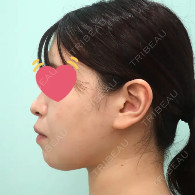 脂肪吸引（顔） / 脂肪冷却（輪郭） WOM CLINIC GINZA （ワム クリニック ギンザ） DAY 31 メイン用