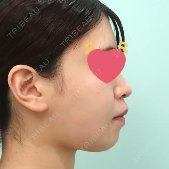 脂肪吸引（顔） / 脂肪冷却（輪郭） WOM CLINIC GINZA （ワム クリニック ギンザ） DAY 31 メイン用