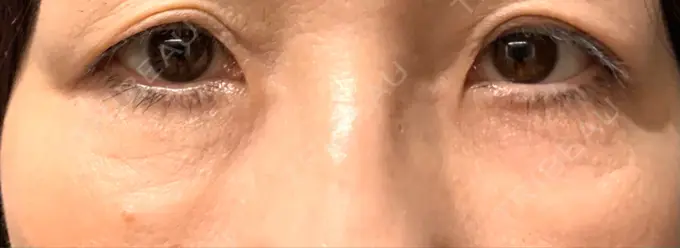 クマ治療 / 下まぶたたるみ取り / 脂肪注入（肌） 湘南美容クリニック 藤沢院 DAY 63 メイン用